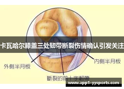 卡瓦哈尔膝盖三处韧带断裂伤情确认引发关注 卡瓦哈尔膝盖三处韧带断裂伤情确认引发关注